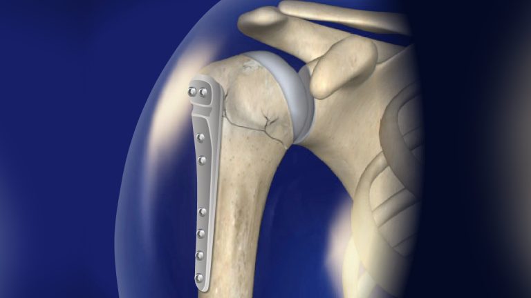 Treating Fractures with ORIF Surgery